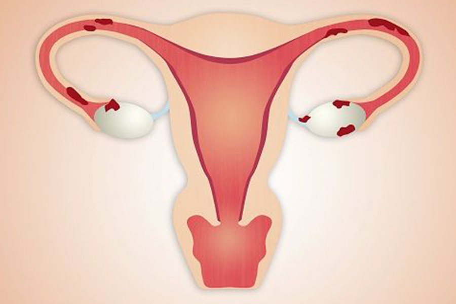 سندرم تخمدان پلی کیستیک(Polycystic Ovary Syndrome (PCOS)) و دردهای شدید پریود