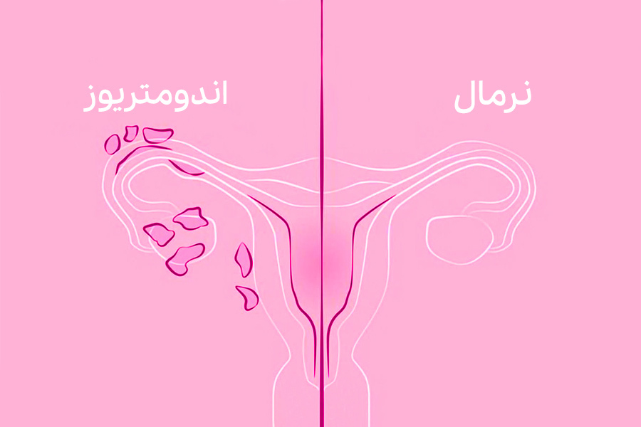 درباره اندومتریوز و راههای درمان آن بدانیم