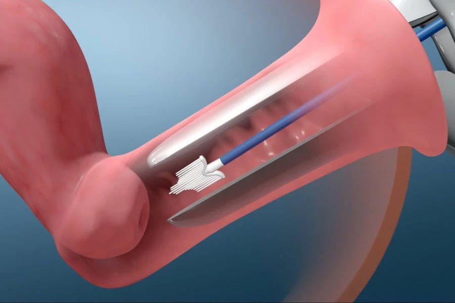 شرایط آماده سازی برای انجام آزمایش (hpv 1)