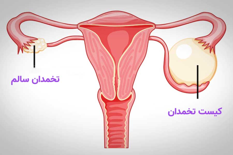 تخمدان سالم و پلی کیستیک