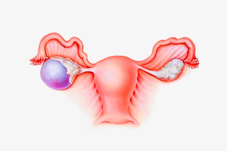 عوامل مؤثر بر ایجاد کیست تخمدان 