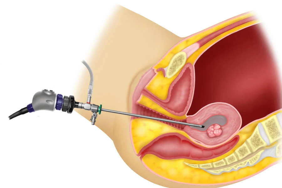هیستروسکوپی