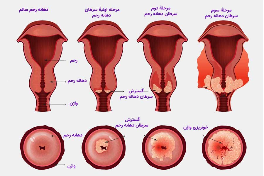 مراحل سرطان دهانه رحم