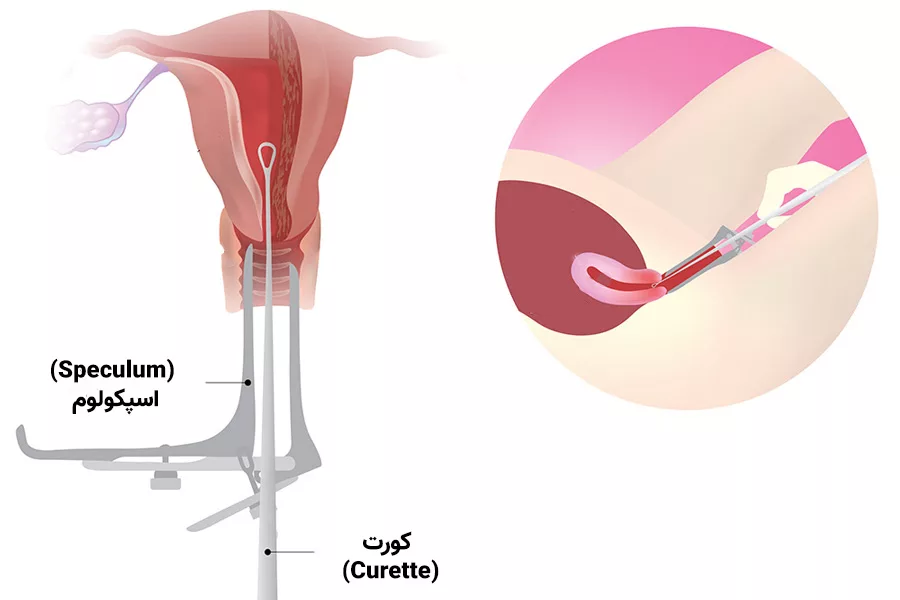 کورتاژ رحم