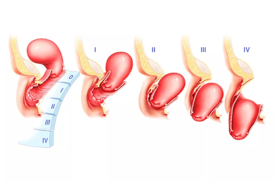 درجات افتادگی رحم