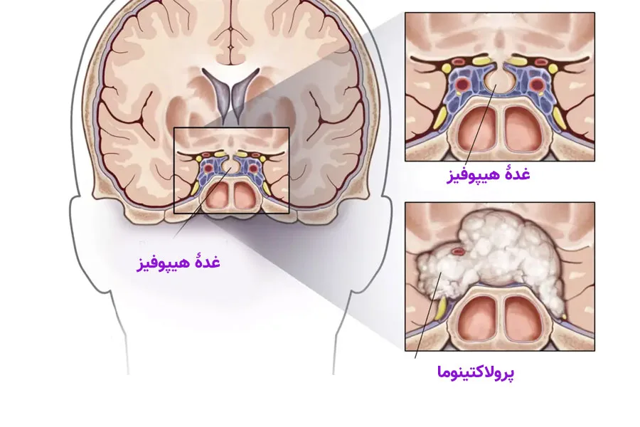 تشخیص و نظارت بر پرولاکتینوما