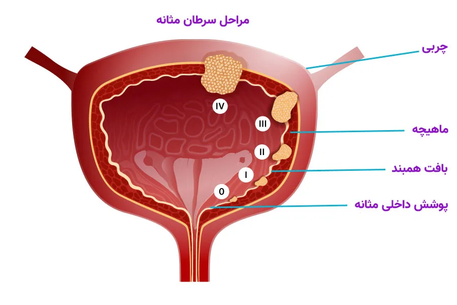 گریدها و مراحل مختلف سرطان مثانه