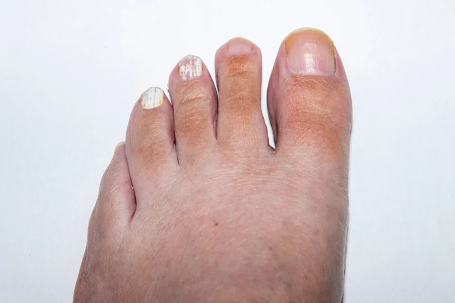 اونیکو مایکوز سطحی سفید (White superficial onychomycosis)