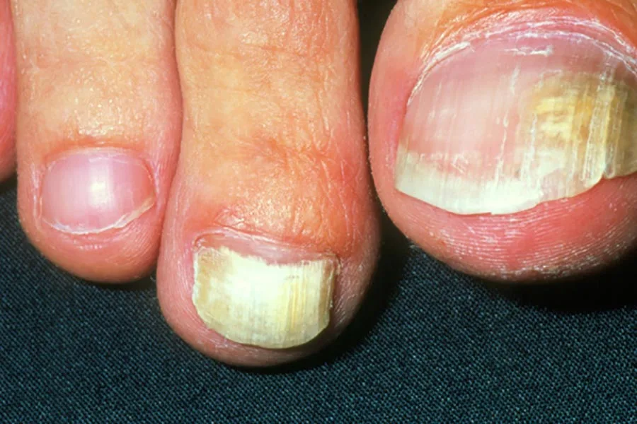 اونیکومایکوز زیرانگوال پروگزیمال (Proximal subungual onychomycosis)