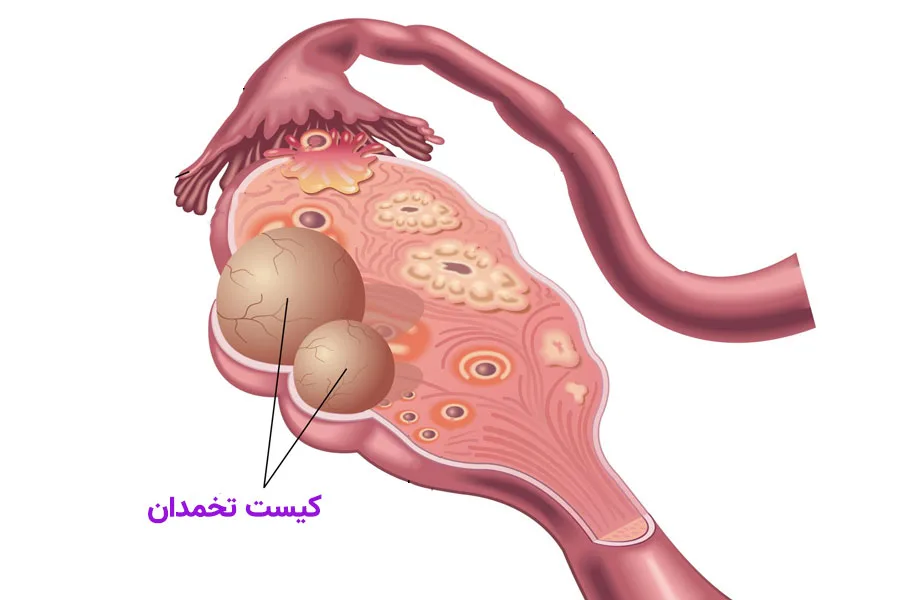 کیست تخمدان