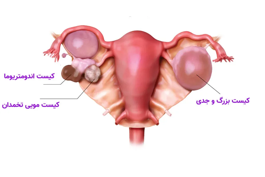 انواع کیست تخمدان