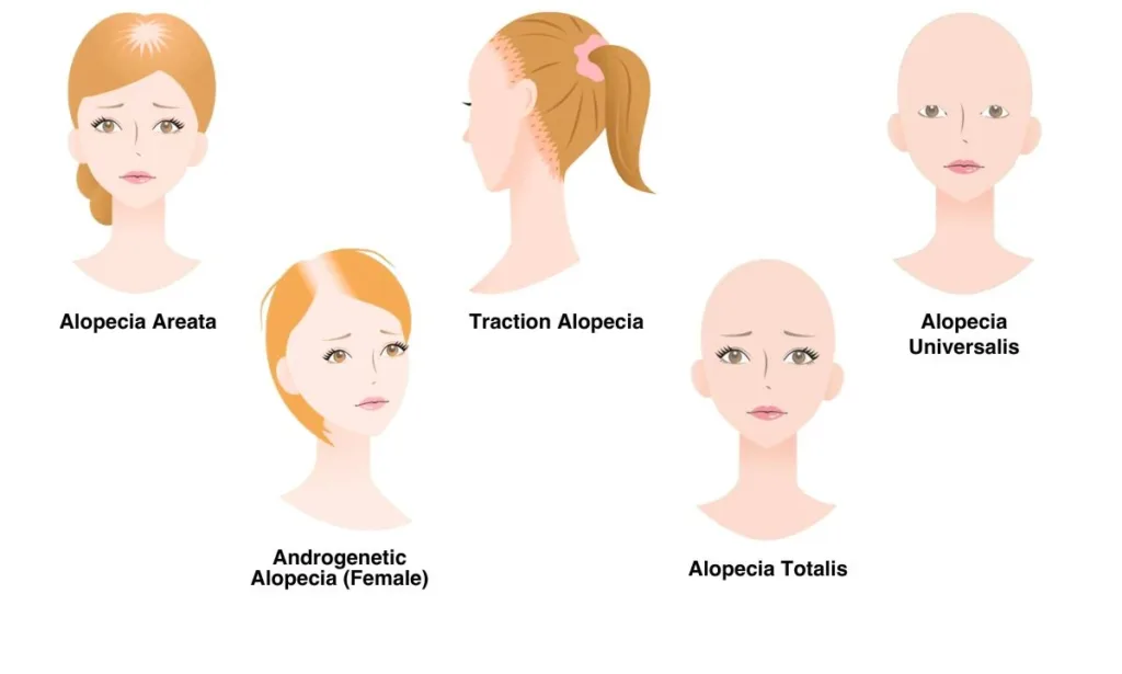 انواع آلوپسی یا ریزش مو در زنان