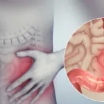 سندروم روده تحریک پذیر (IBS)