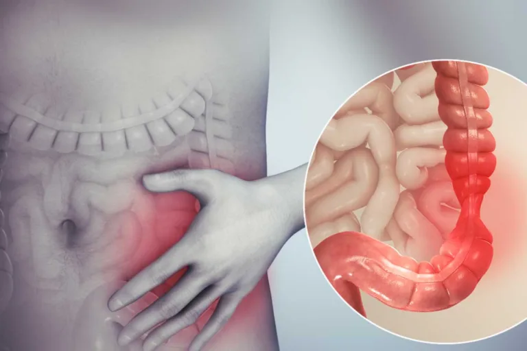 سندروم روده تحریک پذیر (IBS)