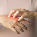 بیماری لوپوس