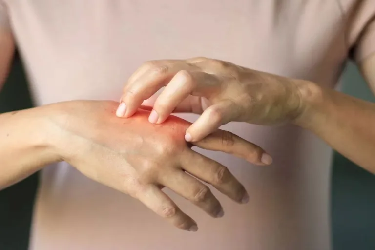 بیماری لوپوس