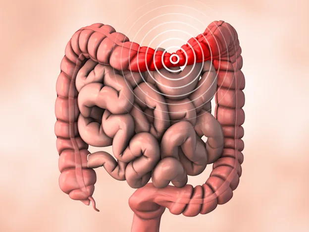 سندرم روده تحریک‌پذیر (IBS)