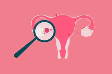 اندومتریوز چیست؟ علائم، علتها و راههای تشخیص